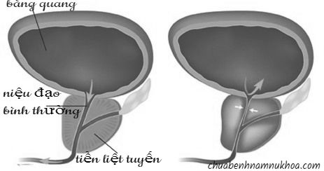 triệu chứng của phì đại tiền liệt tuyến