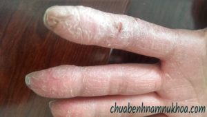 viêm da cơ địa viêm da cơ địa