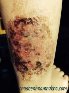 viêm da cơ địa viêm da cơ địa