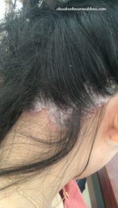 nấm da đầu nấm da đầu