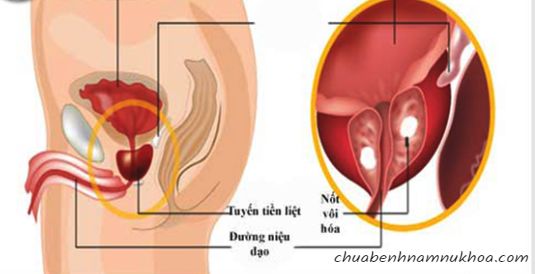 nốt vôi hóa nốt vôi hóa