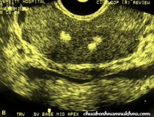 nốt vôi hóa nốt vôi hóa