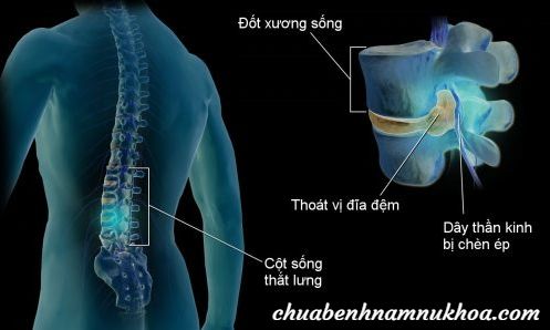 Đau lưng Đau lưng