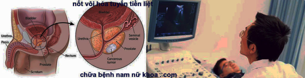 vôi tuyến tiền liệt vôi tuyến tiền liệt