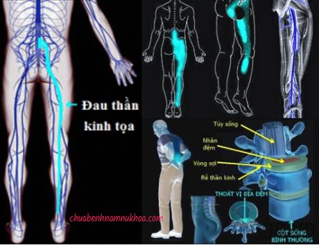 đau thần kinh tọa đau thần kinh tọa