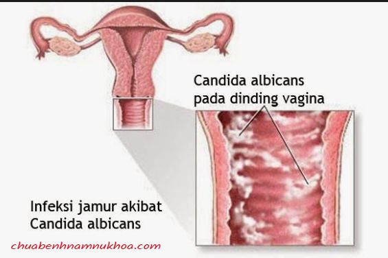 viêm âm đạo viêm âm đạo