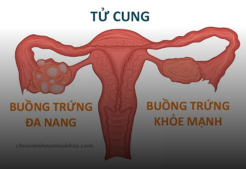 buồng chứng đa nang  buồng chứng đa nang