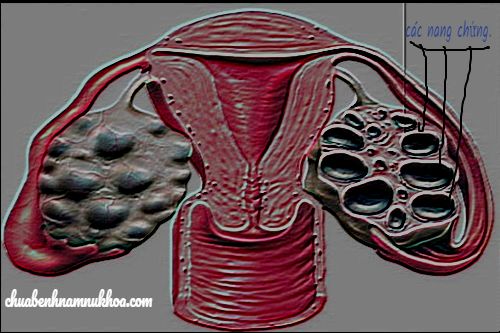 buồng chứng đa nang  buồng chứng đa nang