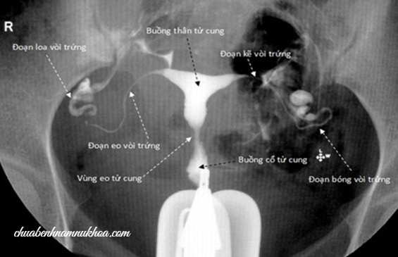 XQ dính vòi trứng dính vòi trứng