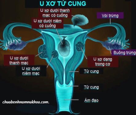 u xơ tử cung u xơ tử cung