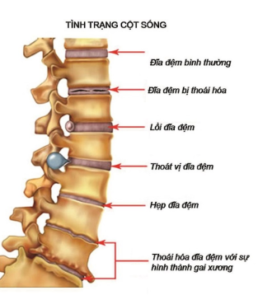 thoái hóa đốt sống cổ thoái hóa đốt sống cổ