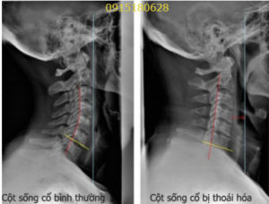 thoái hóa đốt sống cổ thoái hóa đốt sống cổ