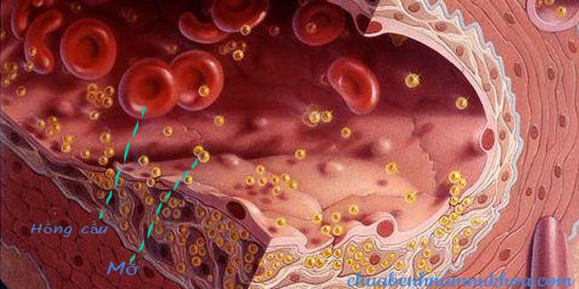 Hình ảnh mỡ trong máu Hình ảnh mỡ trong máu