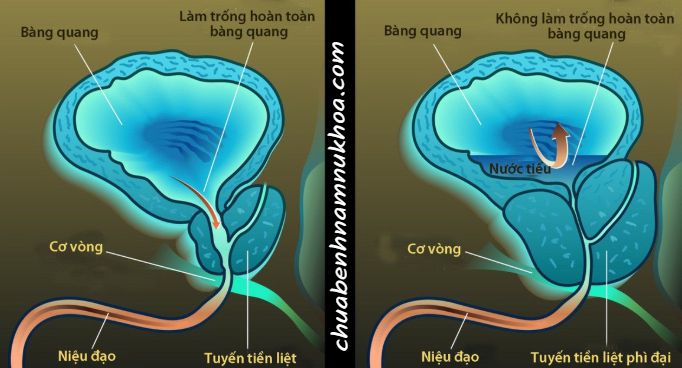 các nang tuyến tiền liệt các nang tuyến tiền liệt