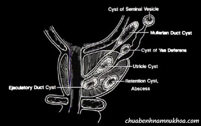 các nang tiền liệt tuyến các nang tiền liệt tuyến