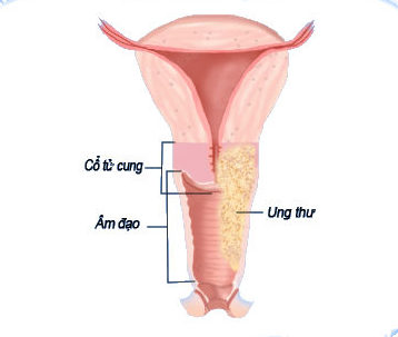 hình ảnh ung thư tử cung hình ảnh ung thư tử cung