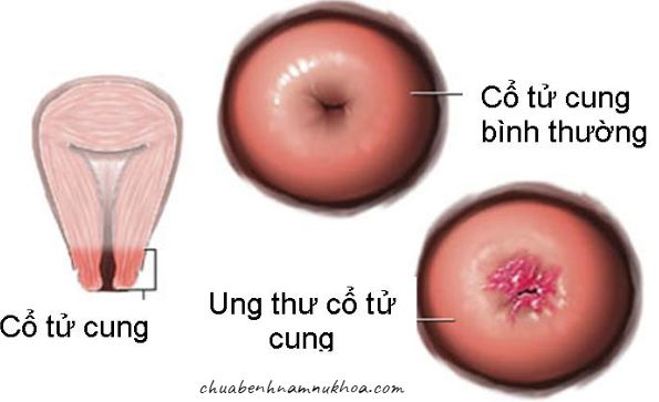 ung thư cổ tử cung ung thư cổ tử cung