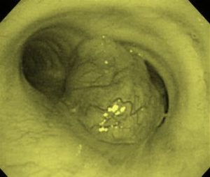 ung thư phổi ung thư phổi