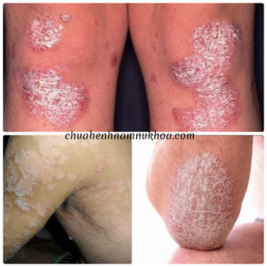Bệnh vẩy nến Bệnh vẩy nến