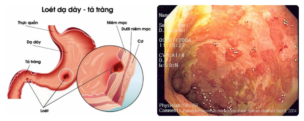 loét dạ dày tá tràng loét dạ dày tá tràng