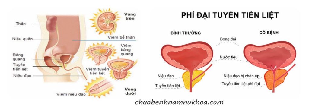 tiền liệt tuyến tiền liệt tuyến