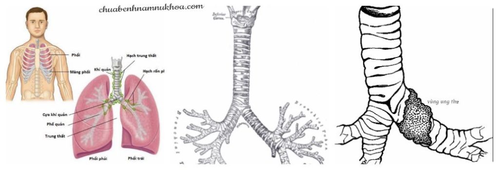 ung thư phế quản ung thư phế quản