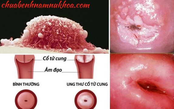 ung thu tử cung ung thu tử cung