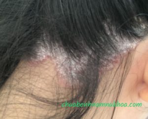 bệnh vẩy nến bệnh vẩy nến