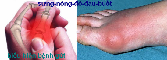 bệnh gút cấp và mạn tính bệnh gút cấp và mạn tính