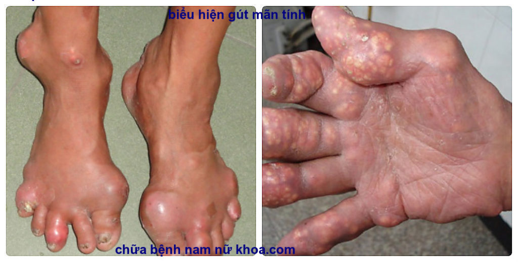 bệnh gút cấp và mạn tính bệnh gút cấp và mạn tính