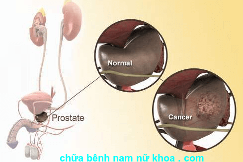viêm tuyến tiền liệt viêm tuyến tiền liệt