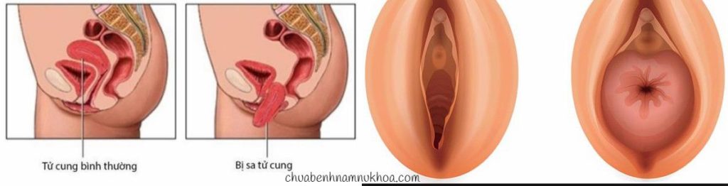 sa tử cung sa tử cung