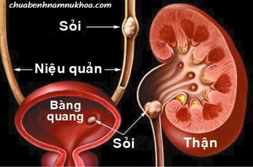 sỏi tiết niệu sỏi tiết niệu