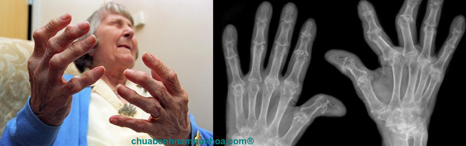 viêm đa khớp dạng thấp viêm đa khớp dạ thấp