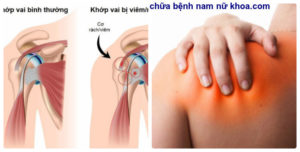 viêm quanh khớp vai viêm quanh khớp vai
