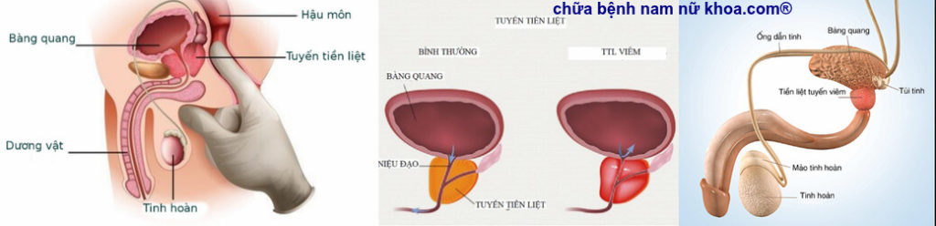 viêm tuyến tiền liệt viêm tuyến tiền liệt