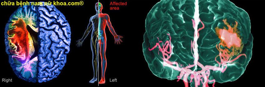 xuất huyết não xuất huyết não