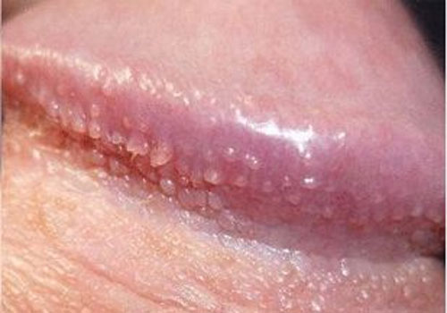 hạt ngọc dương vật